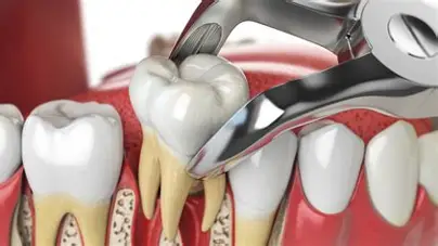 Tooth Extraction